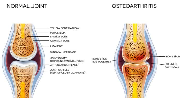 arthritis-diagram